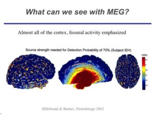 What is Magnetoencephalography (MEG)? | I-LABS